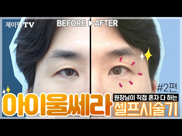 아이울쎄라, 원장님의 셀프시술 도전기 #2탄