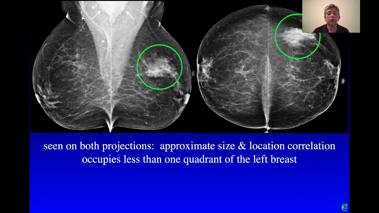 Is breast asymmetry linked to breast cancer?