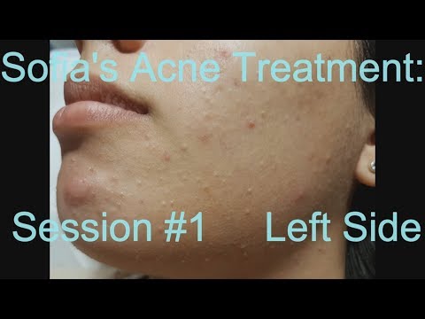 Sofia&#;s Acne Treatment:  Session # -  Left side