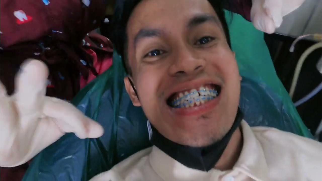 Monthly dapat ang braces adjustment at every 6 months ang tooth cleaning thetoothfairy1866
