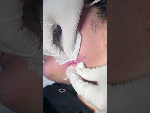 Nặn mụn áp xe vùng quai hàm.