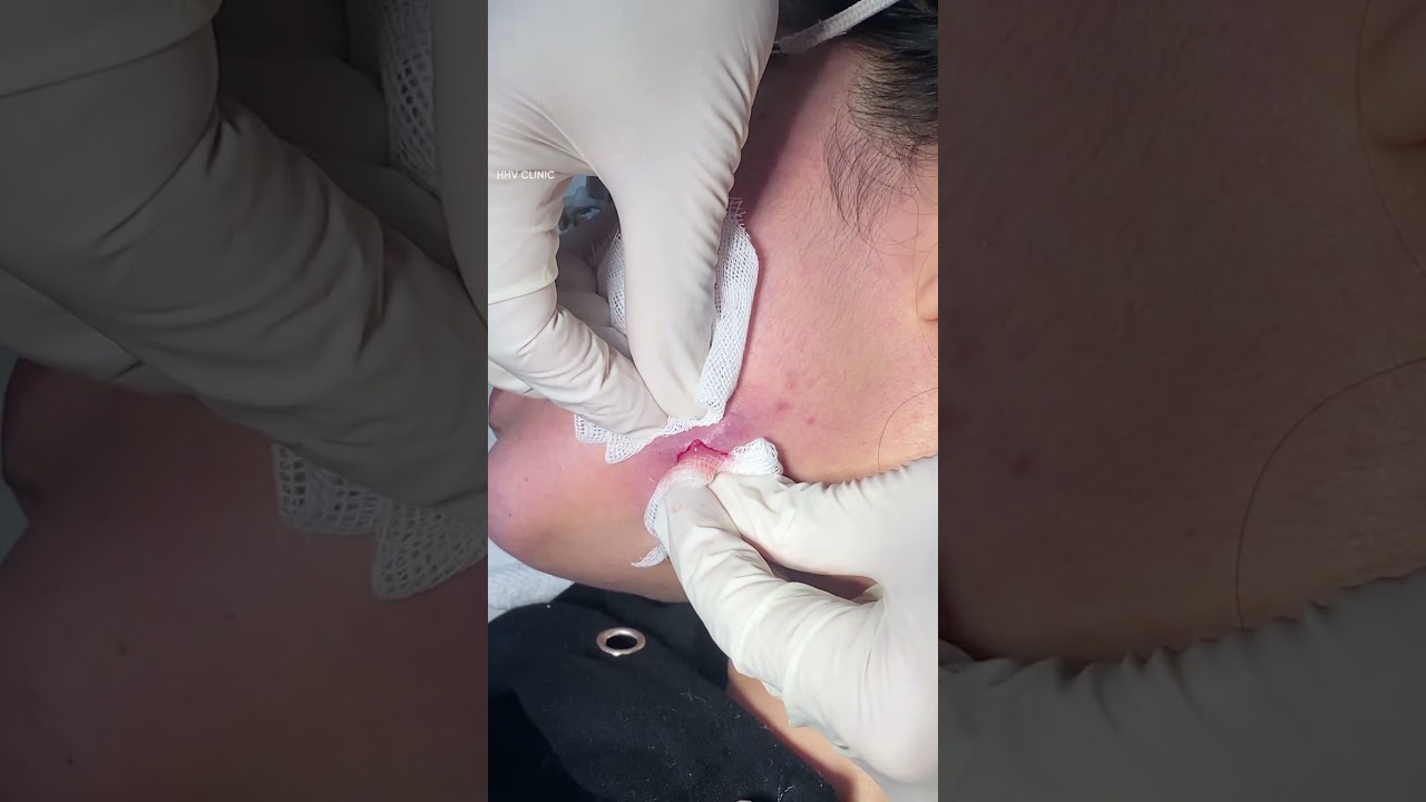 Nặn mụn áp xe vùng quai hàm.