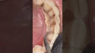 This Much Tartar?! 😬 Dental Cleaning Close-Up (ASMR)