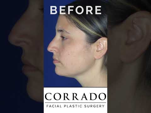 Video thumbnail: Rhinoplasty Reveal in Philadelphia #shorts #rhinoplastyexpert #nosejob #plasticsurgeryreveal · Dr. Anthony Corrado