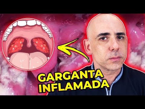 DOR DE GARGANTA: 5 REMÉDIOS CASEIROS BARATOS E FÁCEIS | Dr Dayan Siebra