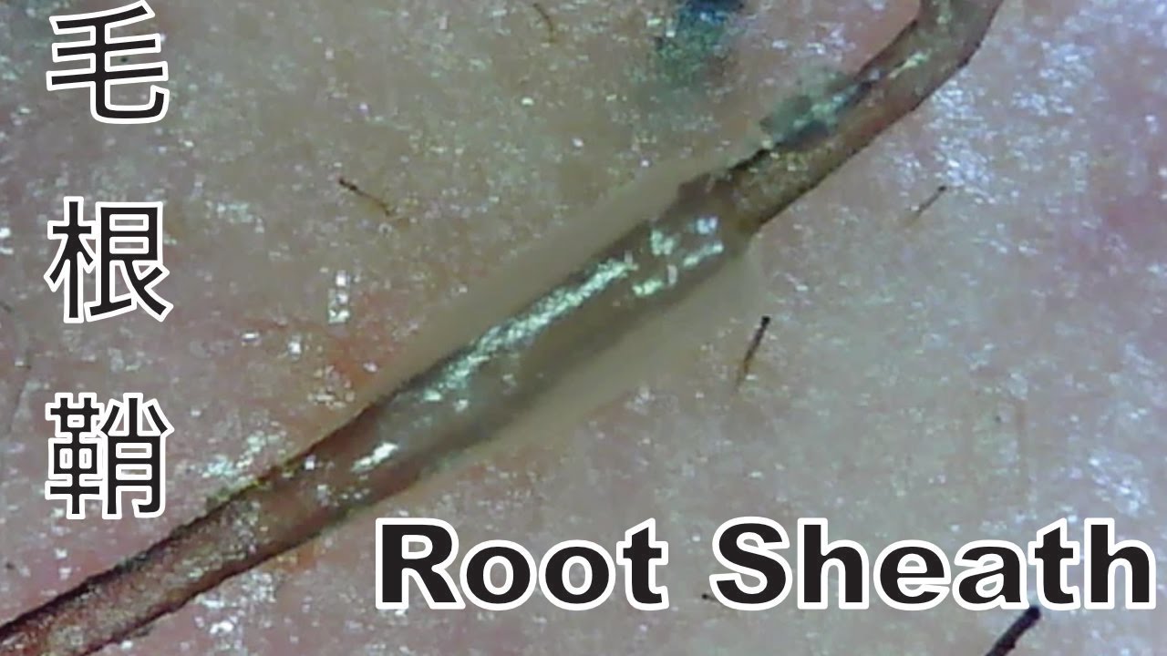 Hair Root Close-Up Part.20 透明ぷよぷよ毛根鞘を超接写【Root-Sheath】 - YouTube