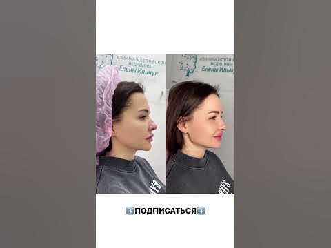 Коррекция углов нижней челюсти: красивые подтянутые черты как у Джоли ...