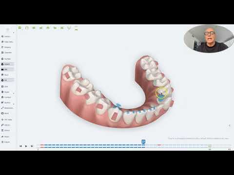 Angel Aligner iOrtho Tips