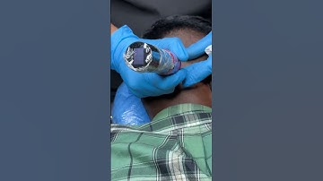 Donor area Scar camouflage with scalp micropigmentation #scalpmicropigmentation #smp #hairloss