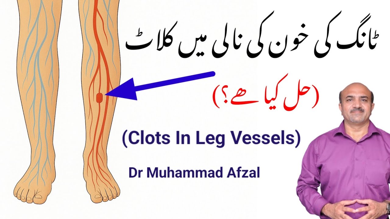 Arterial aur Venous Clots in Legs - Symptoms, Diagnosis aur Treatment Explained!