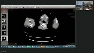 картинка: КТ в дифференциальной диагностике образований печени с кольцевидным паттерном контрастирования