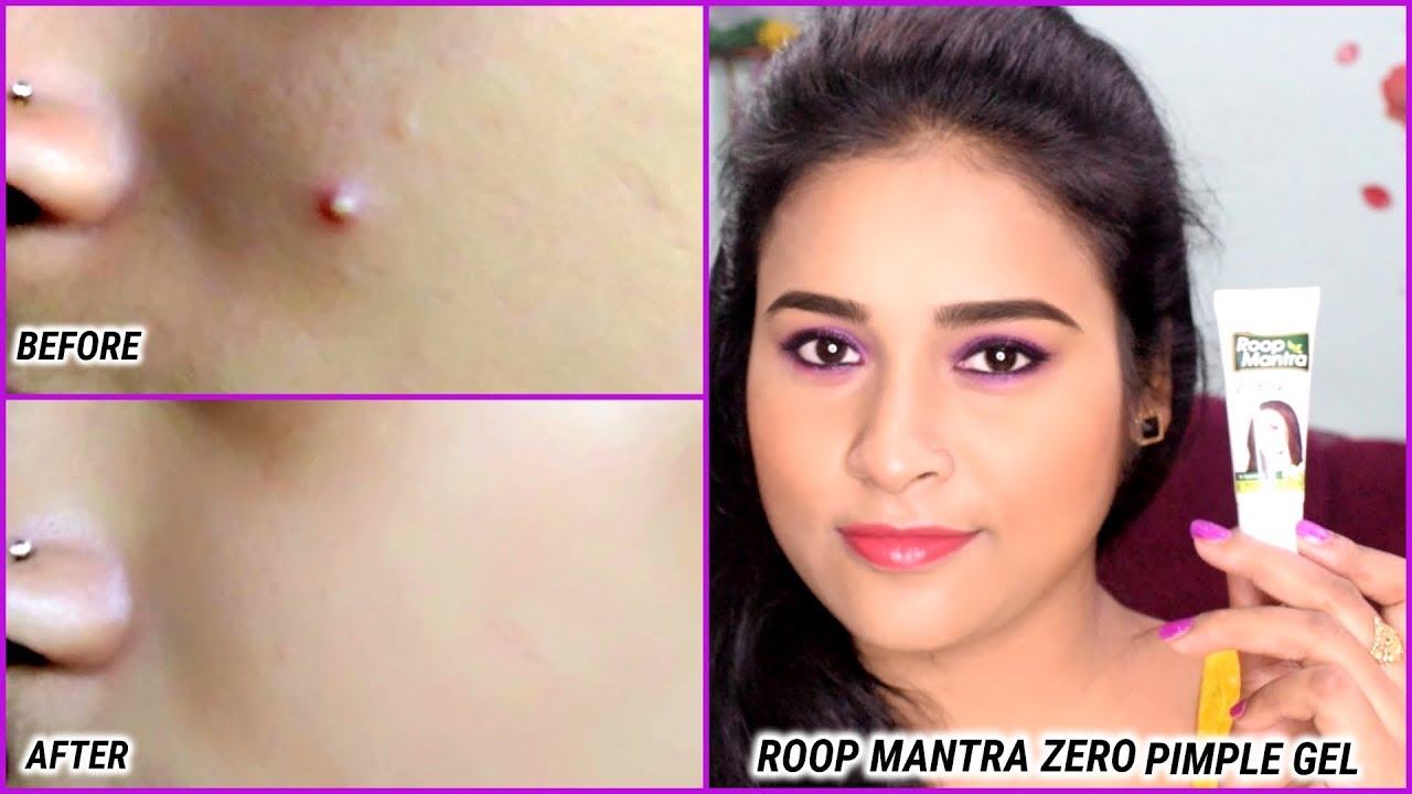 roop mantra acne cream