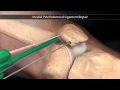 Пластика пателло-феморальной связки (Medial Patellofemoral Ligament Repair)