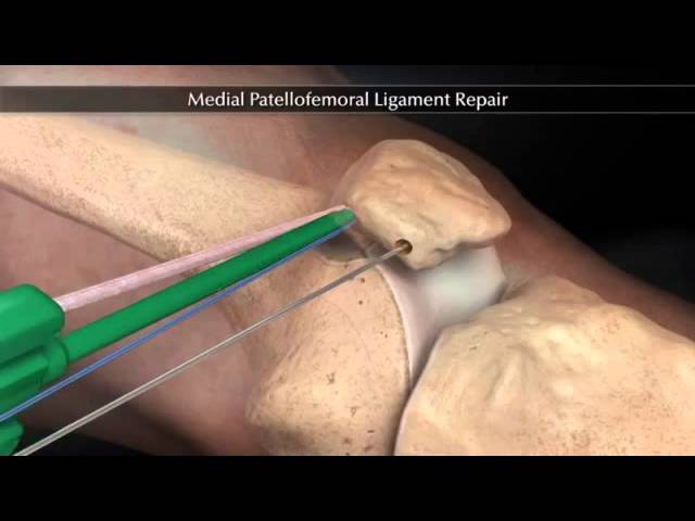 Пластика пателло-феморальной связки (Medial Patellofemoral Ligament Repair)