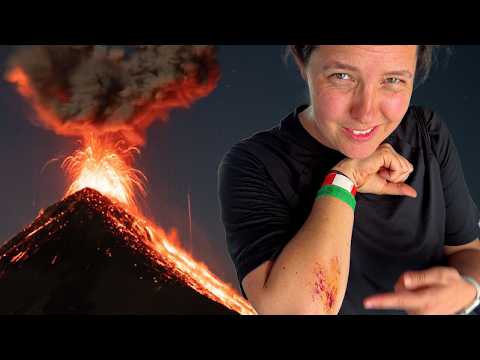 Volcano Injury | Guatemala🇬🇹 6