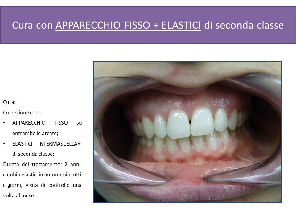 Apparecchio Fisso Prima E Dopo Apparecchio Fisso Prima E Dopo