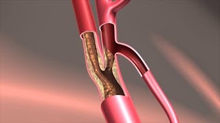 Endarterectomy Treatment