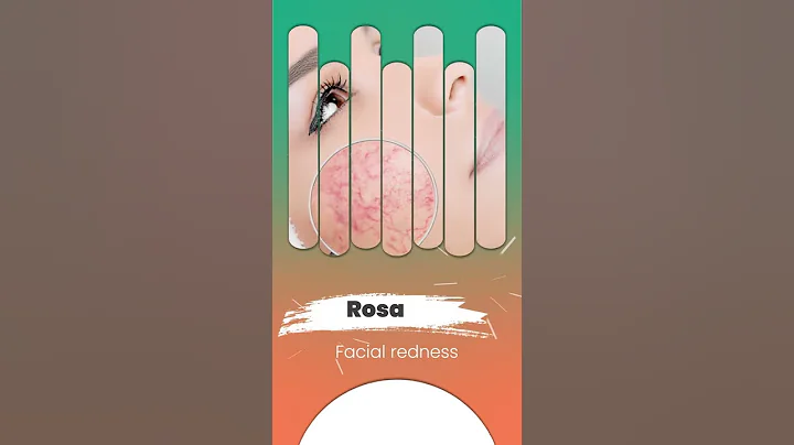 #demodexmites #ungex #treatment Rosacea