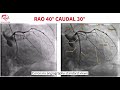 Coronary angiography standard views