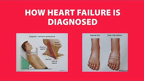 How Heart Failure is Diagnosed