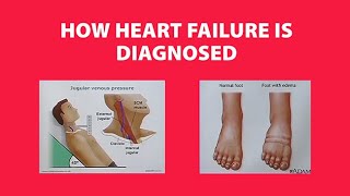 How Heart Failure is Diagnosed