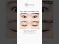 [B&amp;A] 뒤트임+밑트임+눈밑지방재배치 1개월차