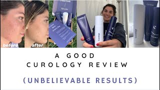 a GOOD curology review + before and after pictures!