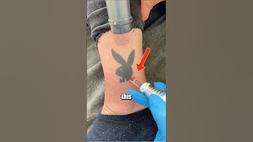 How Laser Tattoo Removal Is Done (@hwclinicbrugge)