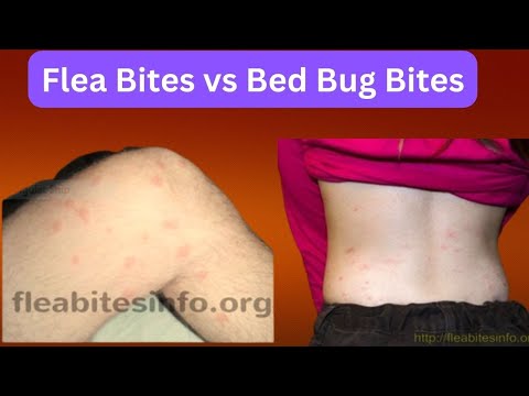 Video: Blšie Uhryznutie Vs. Bedbug Bites: Čo Je To?