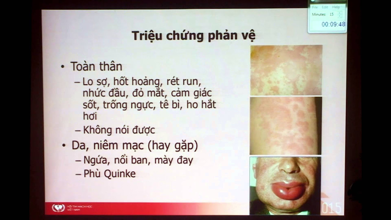 Cập nhật về xử trí sốc phản vệ và phản ứng phản vệ - youtube