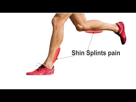 How to Get Rid van Shin splints Fast