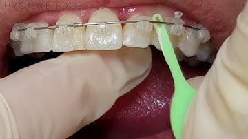 Flossing Ortho Made Easy With The Floss Fish