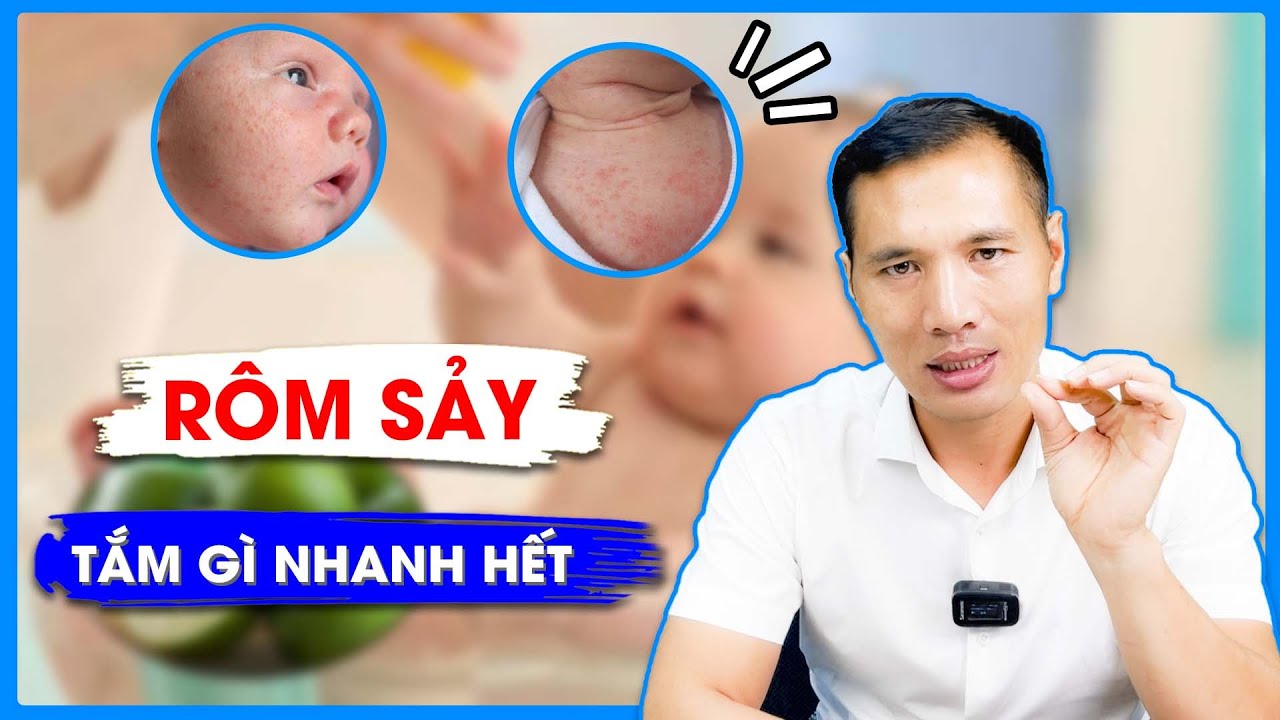TRẺ BỊ RÔM SẢY tắm nước gì NHANH KHỎI? Tham khảo cách PHÒNG NGỪA rôm ...