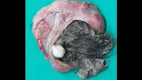 HAIR AND BONE FOUND IN OVARIAN TUMOUR