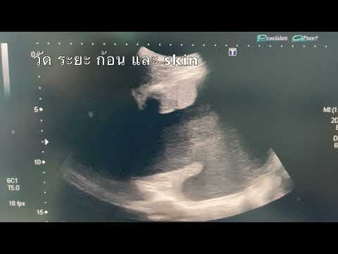 Image Guided Needle Biopsy
