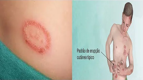 Qual o motivo do aparecimento de impinge?