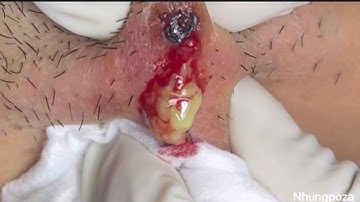 #51 Lông mọc ngược (ingrown hair) gây viêm