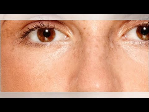 Video: Kosmetologen Förklarade Orsakerna Till Nederlaget I Ansiktet På Arshavins Ex-fru