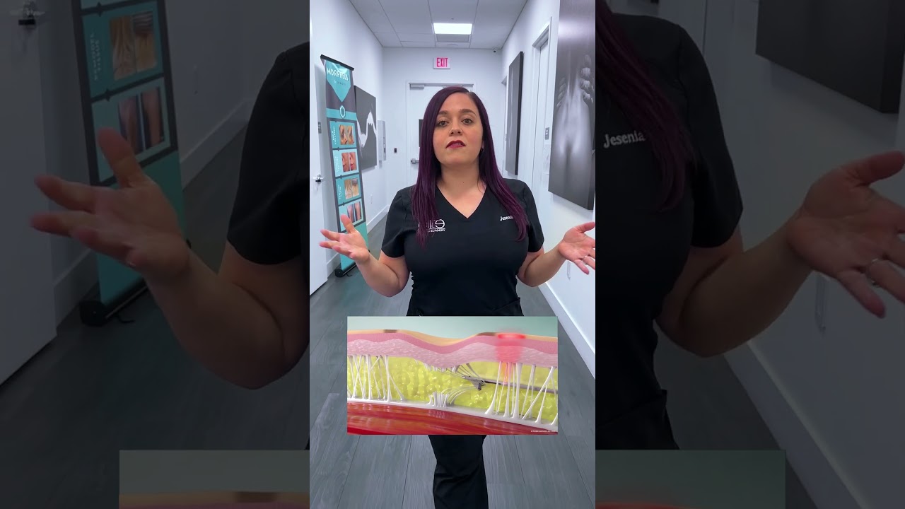 Aveli Cellulite Removal at Elite Plastic Surgery Miami  