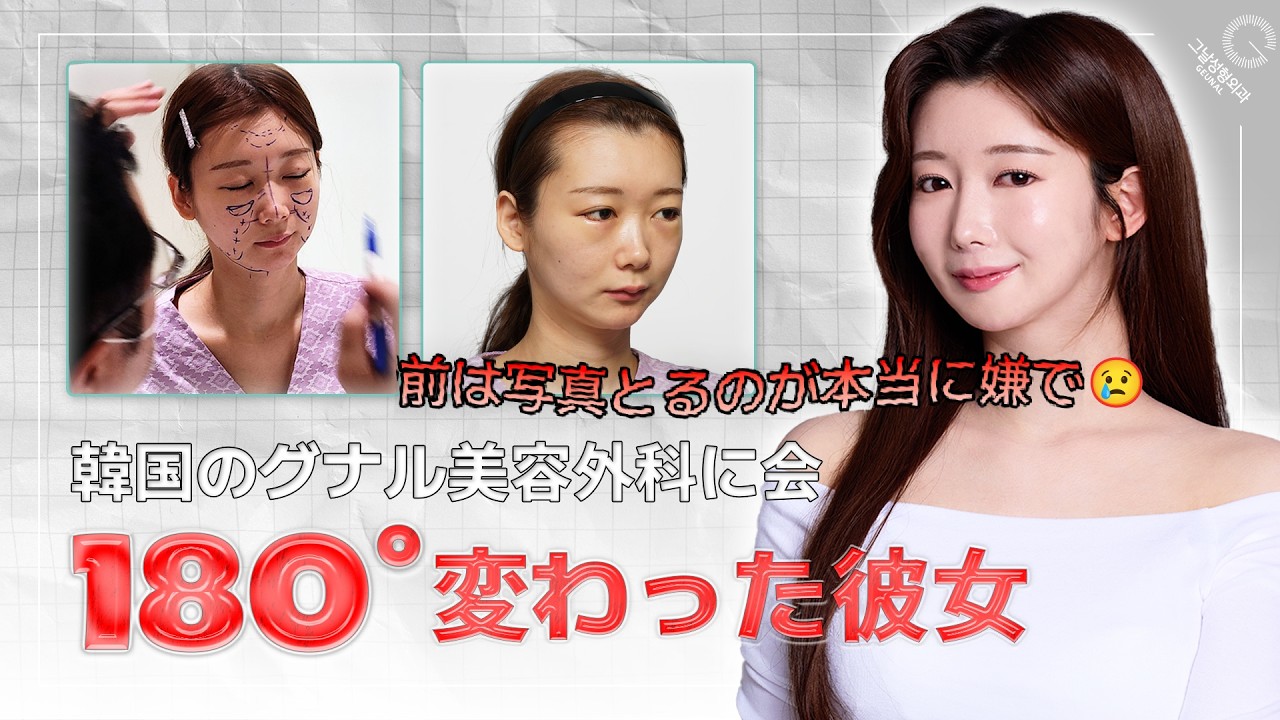 両顎手術後、崩れてしまった鼻と自信… 「その日」 すべてが変わった!
