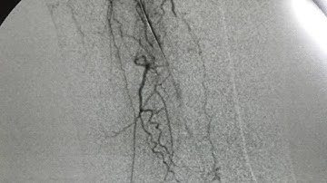 SUPERA stent