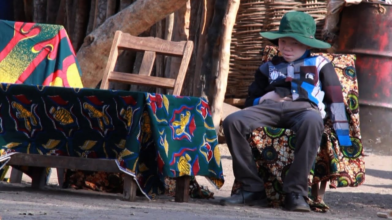 تنزانيا: الإعتداء على مرضى المهق