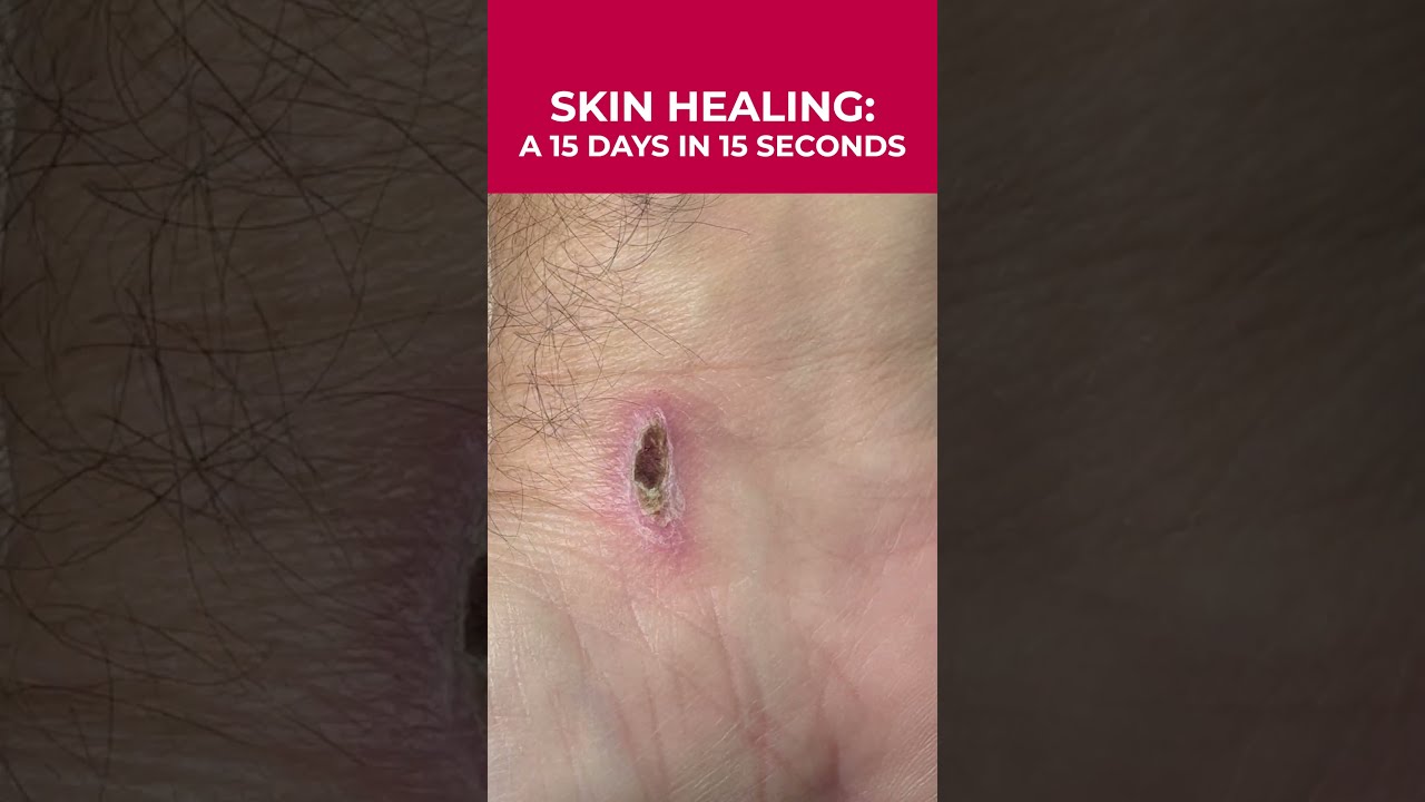15 Days Of Skin Healing In Seconds Amazing Timelapse 