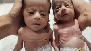 Live: Premature Twin Babies with Low Birth Weight — NICU Care Update 👶💖\\