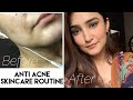 HOW I GOT RID OF MY ACNE - Morning & Night Skincare Routine