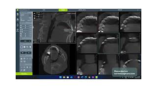 Dentium Training Videos - 3D Viewer Endo Mode