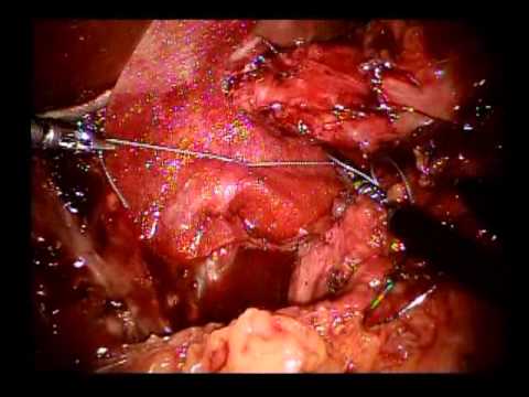 Revision Robotic Nissen Fundoplication refluxo da falta de ar