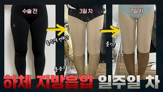 허벅지 종아리 지방흡입 당일 ~ 일주일차 후기 (+출근..가능하냐구요..?)
