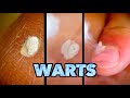 FREEZING 3 WARTS... OUCH! (Finger, Palm, & Knee) | Dr. Paul