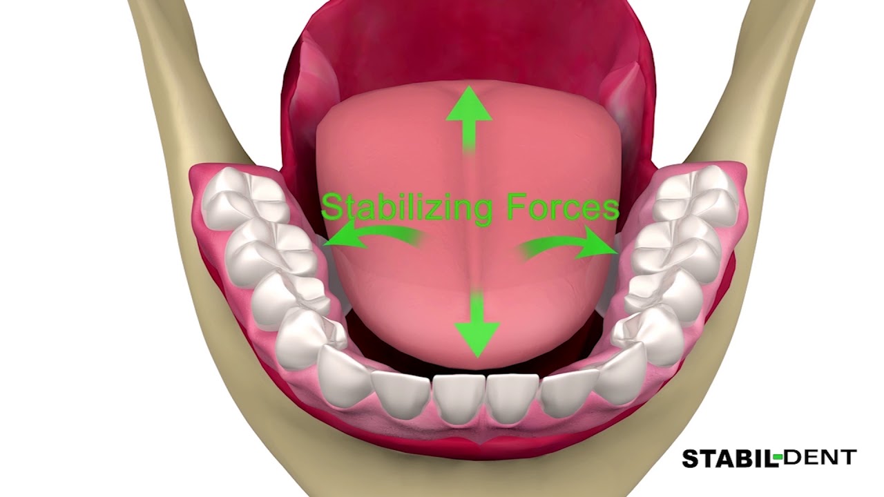Denture Stablizers-How To Keep Lower Dentures In Place